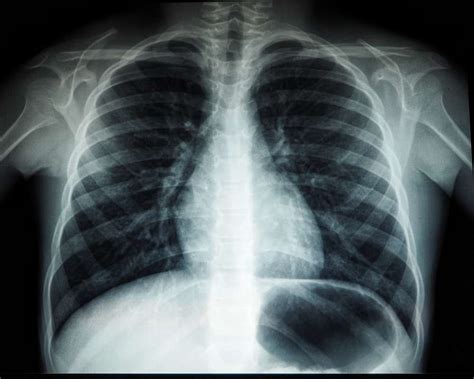 What Chest X.